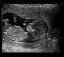 ultrazvukové vyšetření těhotné gynekologie brno